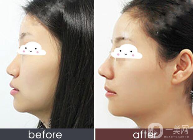 硅膠墊鼻梁多久生包膜？如何避免隆鼻后遺癥？