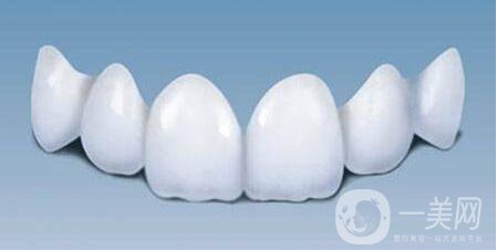 貴金屬烤瓷牙,種類,優(yōu)點(diǎn)