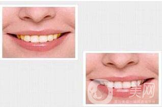 貴金屬烤瓷牙,種類,優(yōu)點(diǎn)