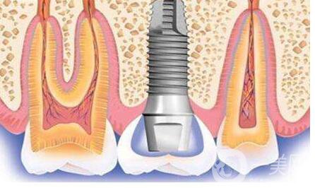 種植牙,術(shù)后注意事項(xiàng)