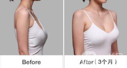 乳房下垂松軟怎么辦？可以做手術(shù)矯正嗎？