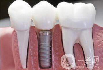 在寧波做人工種植牙一顆價(jià)格是多少