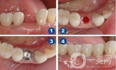 在寧波做人工種植牙一顆價(jià)格是多少