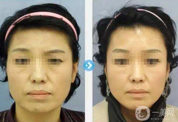 小切口面部提升手術(shù),抗衰,*果