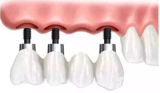 種植牙的利與弊 