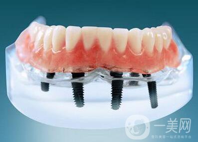 上海九院種植牙價(jià)格要多少錢(qián)？