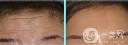 激光去抬頭紋怎么樣、*果*嗎