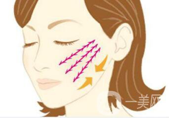 北京醫(yī)院做面部提升一次價(jià)格一般是多少