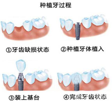 鄭州,種植牙,價(jià)格