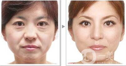 *除皺*嗎？可以維持多久的時間？