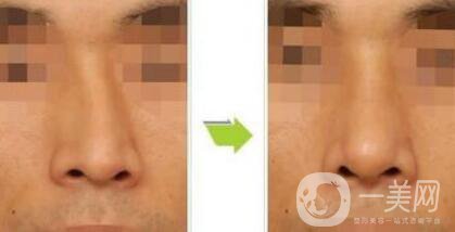 歪鼻矯正術(shù)難度大嗎？手術(shù)注意事項有哪些？