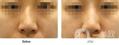 歪鼻矯正術(shù)難度大嗎？手術(shù)注意事項有哪些？