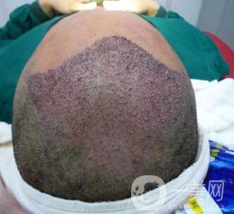 北京醫(yī)院做人工頭發(fā)種植價(jià)格 發(fā)際線后移也不是問題 