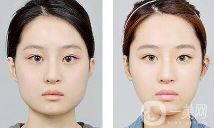 怎樣變瓜子臉？可以打*嗎？