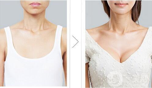 假體隆胸恢復期要多久 假體隆胸輕松擁有網(wǎng)紅傲人身材