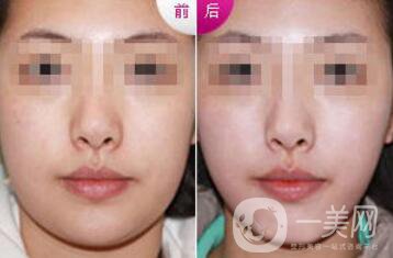 雙下巴怎么減才快速*？去雙下巴方法介紹