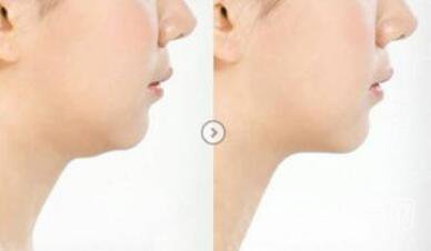 雙下巴怎么減才快速*？去雙下巴方法介紹