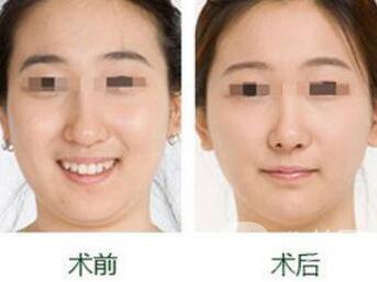 雙下巴怎么減才快速*？去雙下巴方法介紹