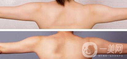 如何快速瘦手臂 手臂吸脂能瘦嗎