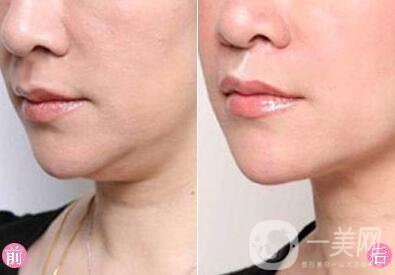 雙下巴吸脂術(shù)前準(zhǔn)備需要做哪些？