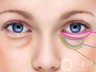 內(nèi)切祛眼袋多久恢復(fù)？