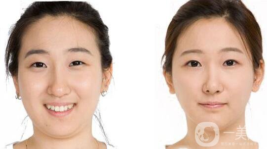 去頰脂墊瘦臉,*果