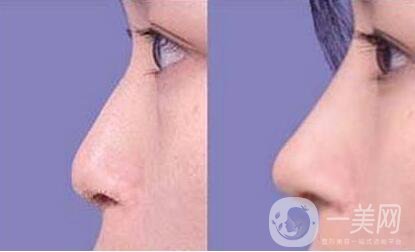 上海,鼻翼縮小.多少錢(qián)