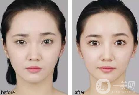 開內(nèi)眼角要多久恢復(fù) 恢復(fù)期長短和哪些因素有關(guān)