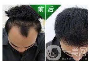 蛋白纖維植發(fā)好不好 術(shù)前術(shù)后展示