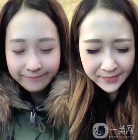 去頰脂墊有后遺癥嗎 后遺癥有哪些