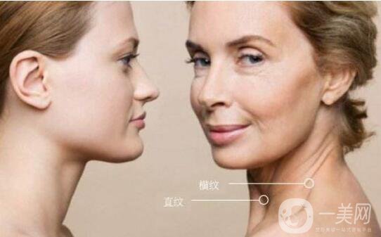 如何去掉頸紋 *去除頸紋的方法有哪些