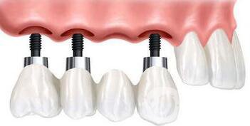 深圳種植牙費用表 影響種植牙價格因素
