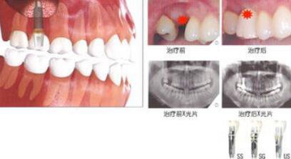深圳種植牙費用表 影響種植牙價格因素