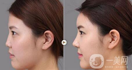 膨體隆鼻缺點(diǎn)主要有哪些？危害大嗎？