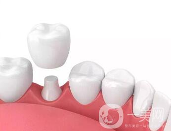 深圳做烤瓷牙一般要多少錢