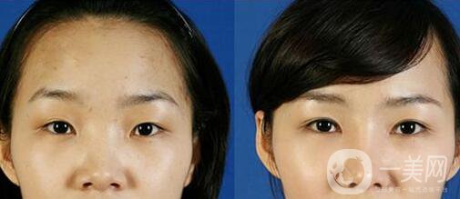 開(kāi)內(nèi)外眼角多少錢？開(kāi)眼角價(jià)格盤點(diǎn)！