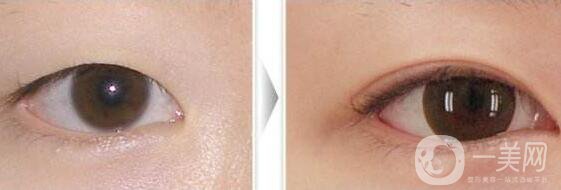 開眼角手術前后，術后*果杠杠的！