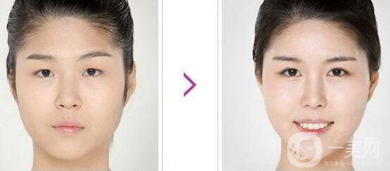 開眼角手術前后，術后*果杠杠的！