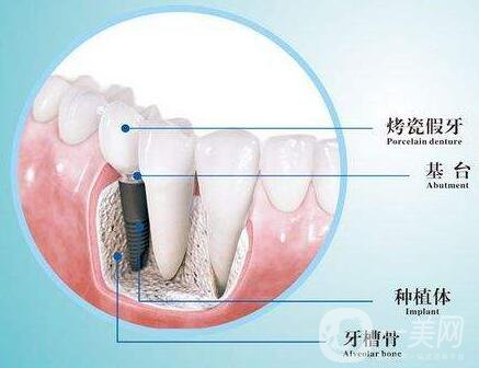 人工種植牙的價(jià)格要多少錢？