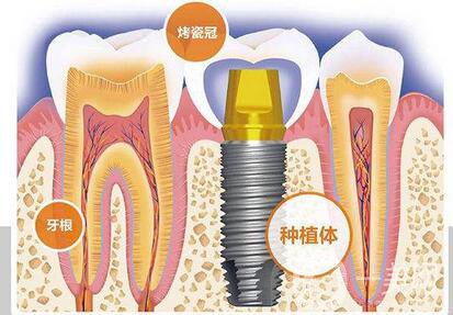 人工種植牙的價(jià)格要多少錢？