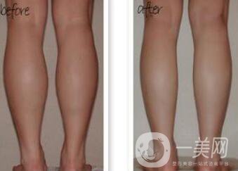 小腿吸脂能瘦幾厘米 輕松擁有纖細雙腿