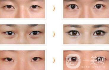 哪些人不適合做雙眼皮手術(shù)