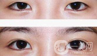 埋線雙眼皮多久消腫？幾天可以恢復自然