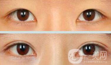 埋線雙眼皮多久消腫？幾天可以恢復自然