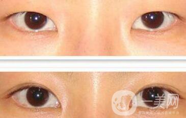 埋線雙眼皮多久消腫？幾天可以恢復自然