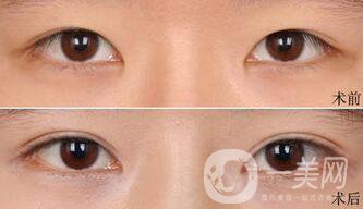 納米*雙眼皮術(shù)后注意事項有哪些
