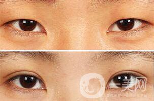 納米*雙眼皮術(shù)后注意事項有哪些