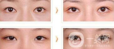 全切雙眼皮術(shù)后吃什么？術(shù)后如何護(hù)理