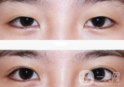 全切雙眼皮術(shù)后吃什么？術(shù)后如何護(hù)理