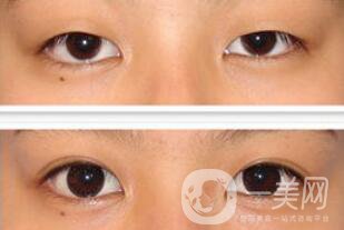 全切雙眼皮術(shù)后怎么護(hù)理？需要注意什么